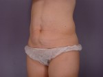 Liposuction Before and after photo