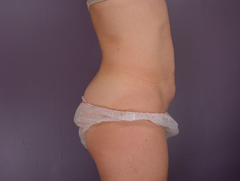 Liposuction before and after photo