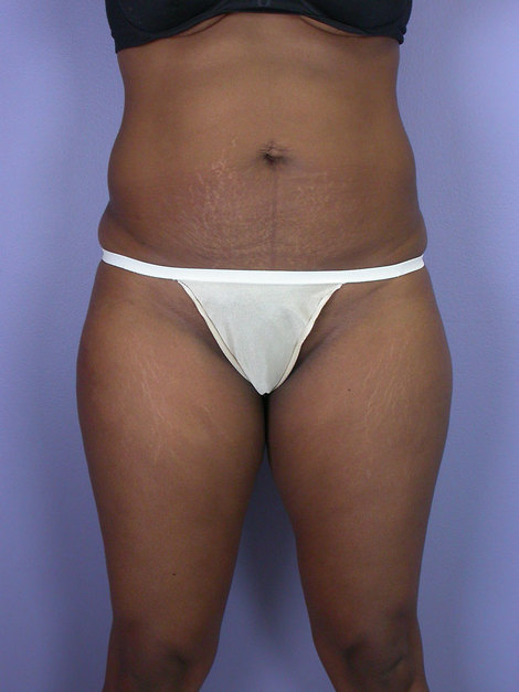 Liposuction before and after photo