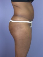 Liposuction Before and after photo