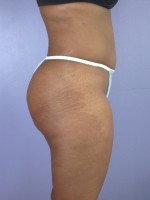 Liposuction Before and after photo