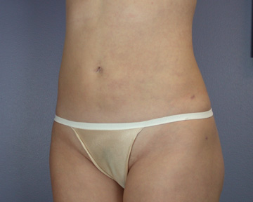 Liposuction before and after photo