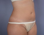 Liposuction Before and after photo