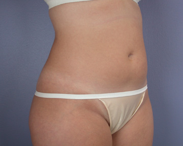 Liposuction before and after photo