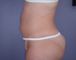 Liposuction Before and after photo