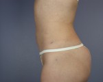 Liposuction Before and after photo