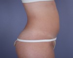 Liposuction Before and after photo