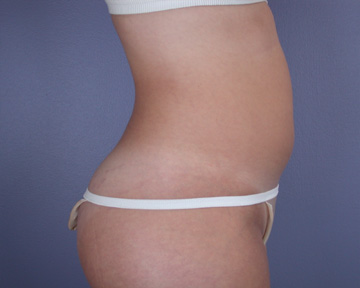 Liposuction before and after photo