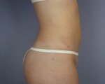 Liposuction Before and after photo