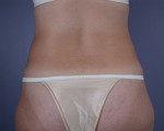 Liposuction Before and after photo