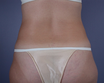 Liposuction before and after photo