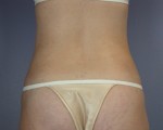 Liposuction Before and after photo