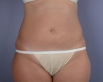 Liposuction Before and after photo