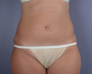 Liposuction before and after photo