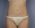 Liposuction