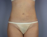 Liposuction Before and after photo