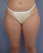 Liposuction Before and after photo