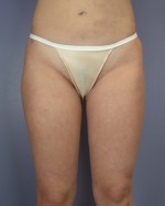 Liposuction Before and after photo