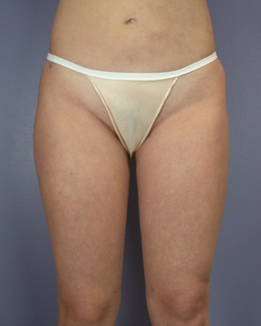 Liposuction before and after photo