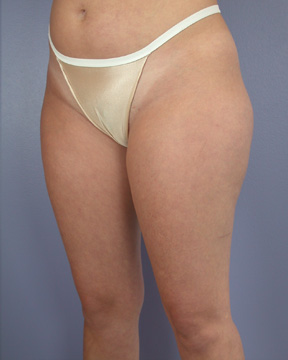 Liposuction before and after photo