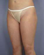 Liposuction Before and after photo