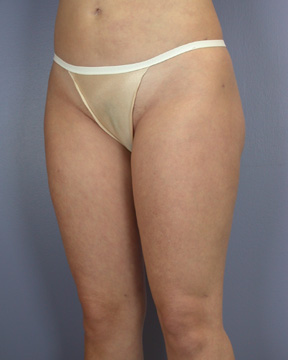 Liposuction before and after photo