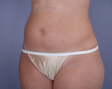 Liposuction before and after photo