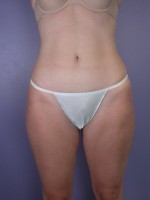 Liposuction Before and after photo