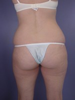 Liposuction Before and after photo