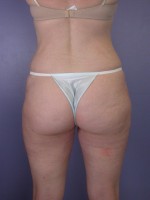 Liposuction Before and after photo