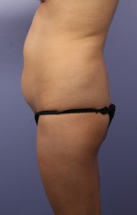 Liposuction Before and after photo