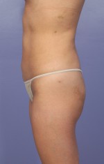 Liposuction Before and after photo