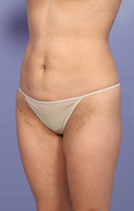 Liposuction before and after photo