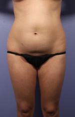 Liposuction Before and after photo