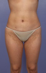 Liposuction Before and after photo