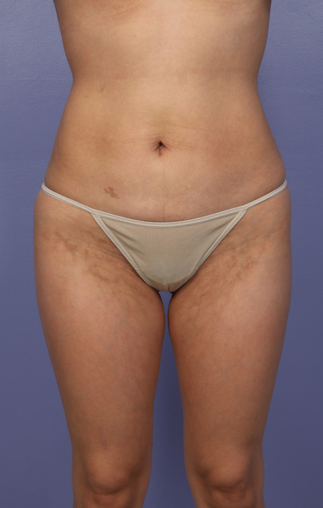 Liposuction before and after photo