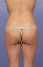 Liposuction Before and after photo