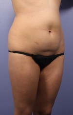 Liposuction Before and after photo