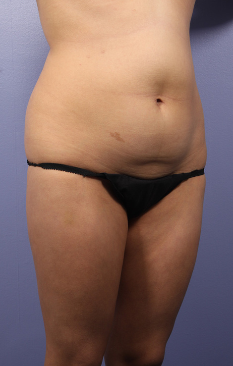 Liposuction before and after photo