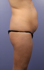 Liposuction Before and after photo