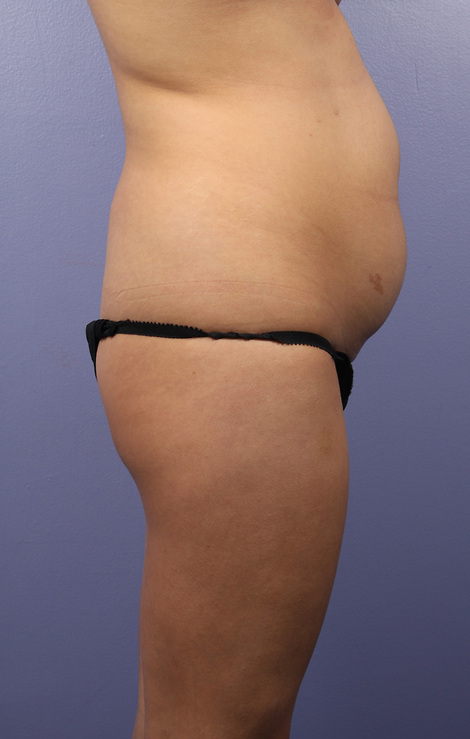 Liposuction before and after photo