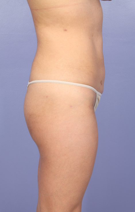 Liposuction before and after photo