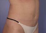 Liposuction Before and after photo