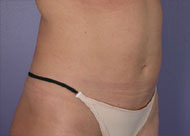 Liposuction before and after photo