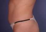 Liposuction Before and after photo