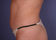 Liposuction before and after photo