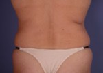 Liposuction Before and after photo