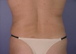 Liposuction Before and after photo