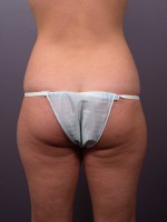 Liposuction Before and after photo