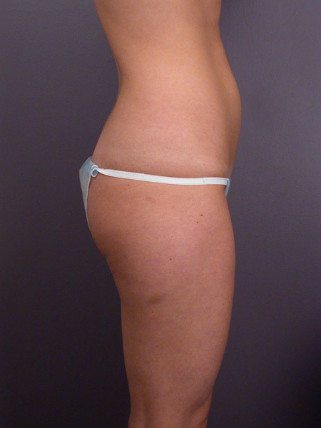 Liposuction before and after photo